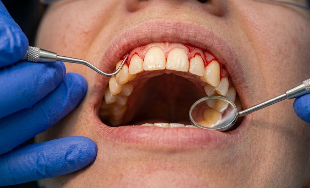 Badanie periodontologiczne dziąseł